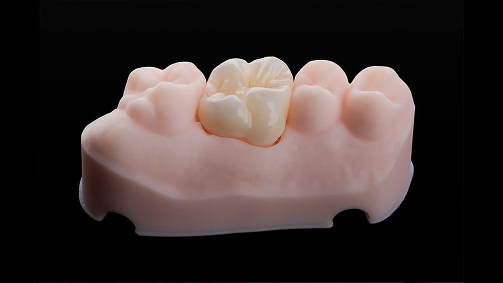 オールセラミック