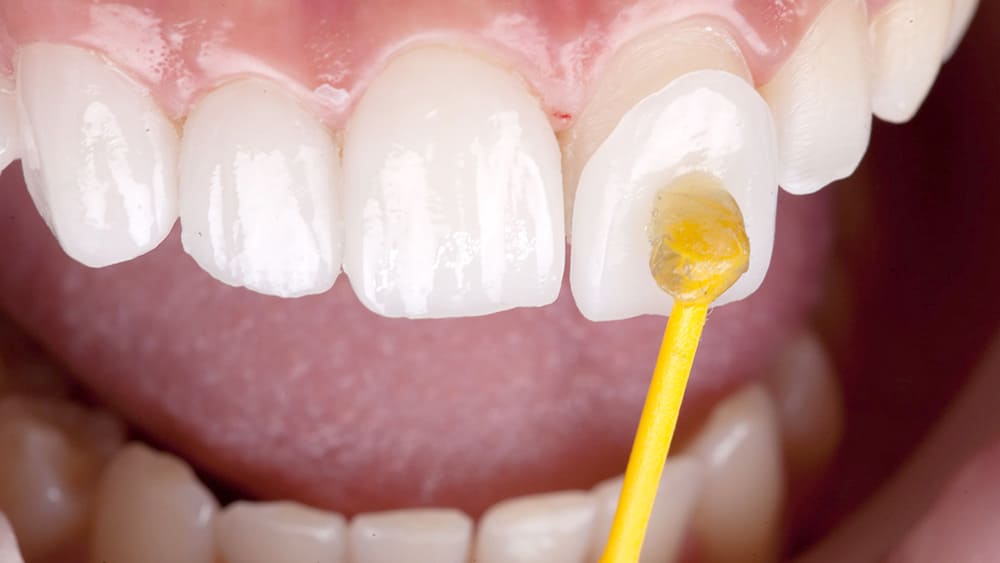 ラミネートベニア