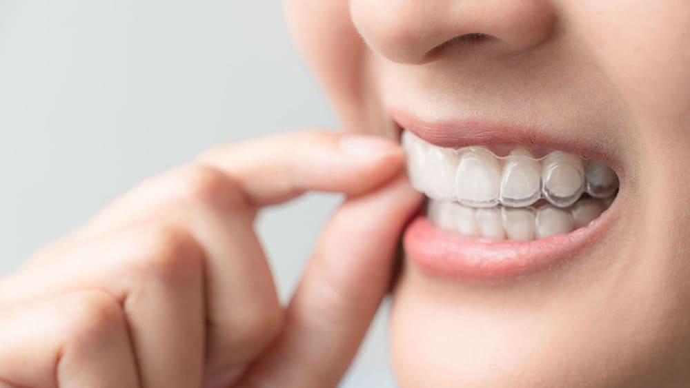 マウスピース矯正