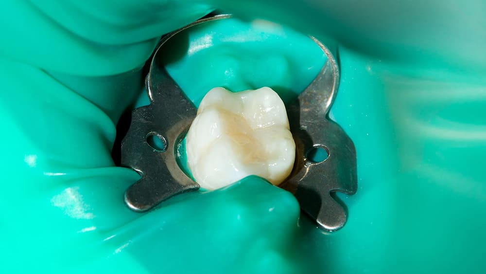 清潔な環境で行う一般歯科治療