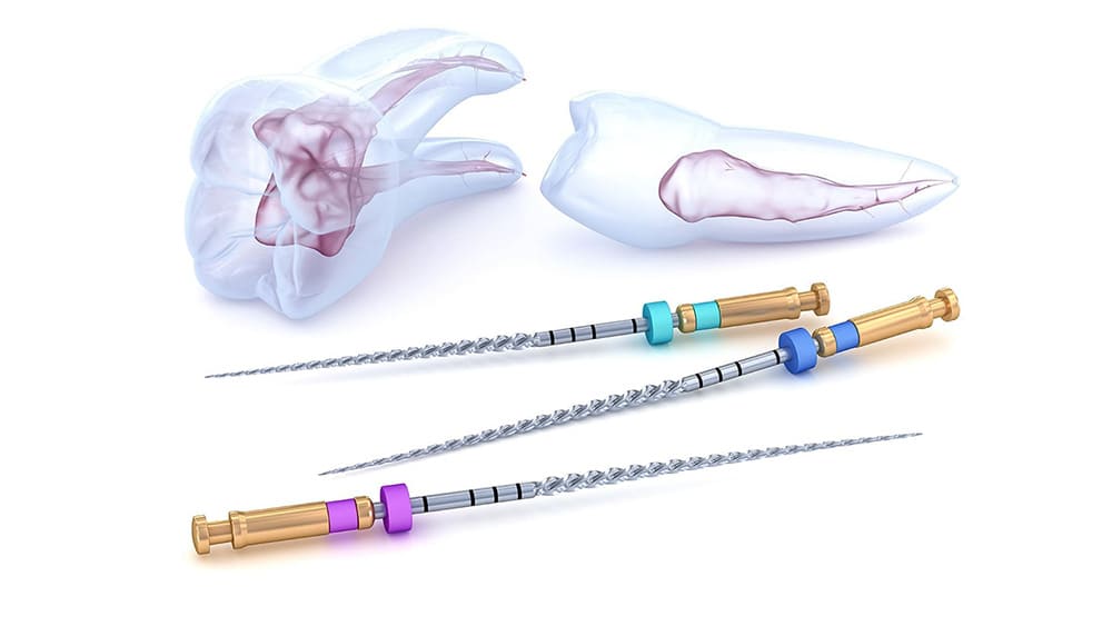 ニッケルチタンファイル