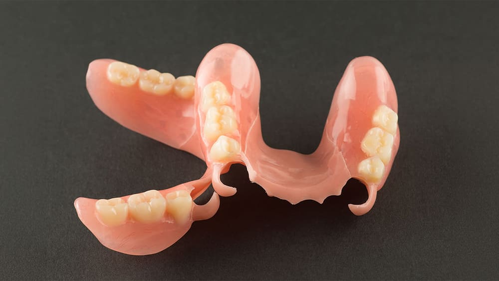 ノンクラスプデンチャー