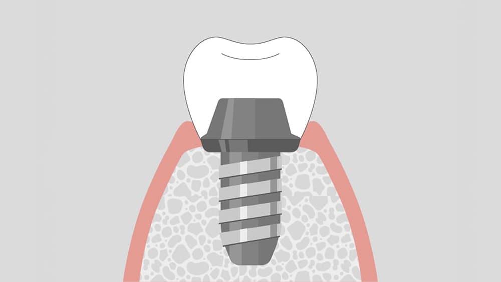 トップダウントリートメント