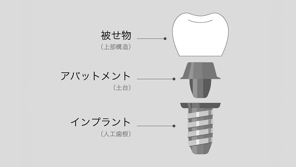 インプラント構造