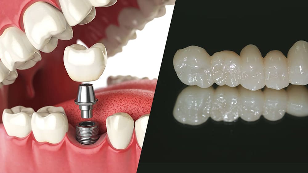 インプラント手術