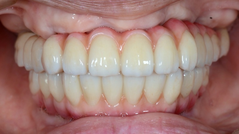 インプラント症例：上下の歯がぐらぐらして噛めない（オールオンフォー）