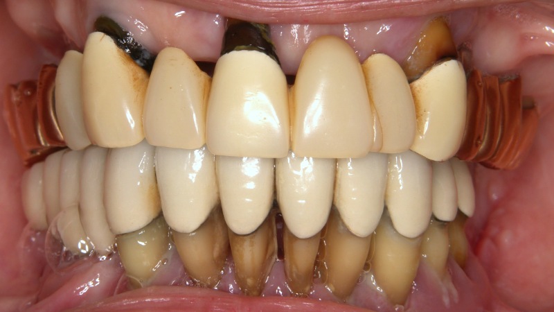 インプラント症例：上下の歯がぐらぐらして噛めない（オールオンフォー）