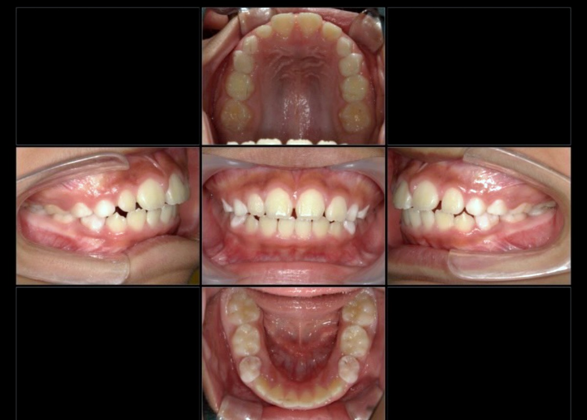 小児矯正症例：前歯で噛めない(開咬)