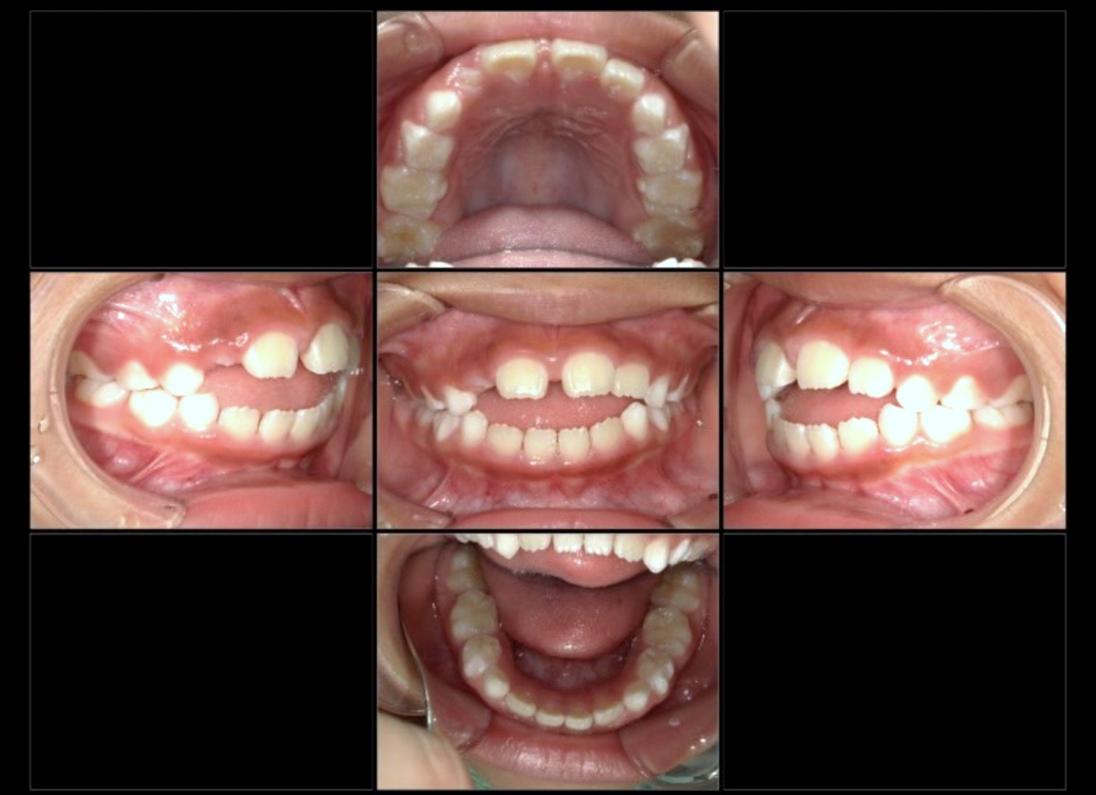 小児矯正症例：前歯で噛めない(開咬)