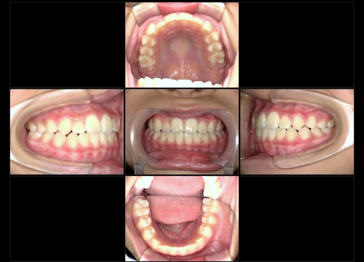 小児矯正症例：受け口、下の前歯のジグザグ(叢生)