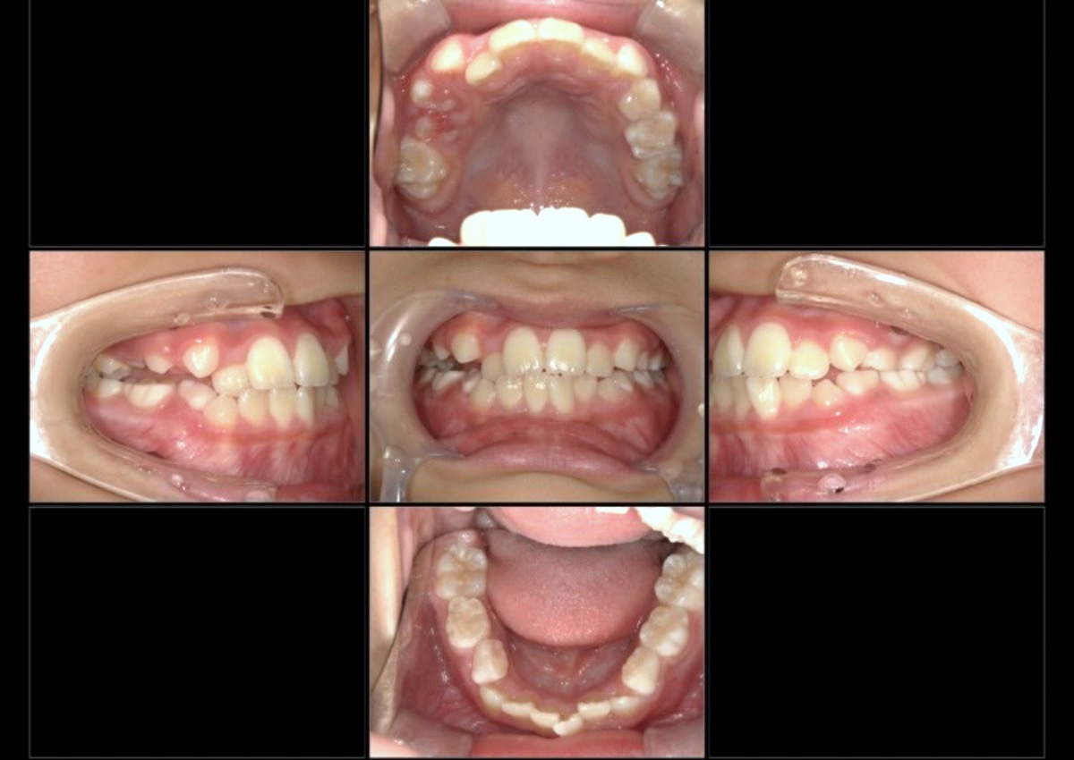 小児矯正症例：受け口、下の前歯のジグザグ(叢生)