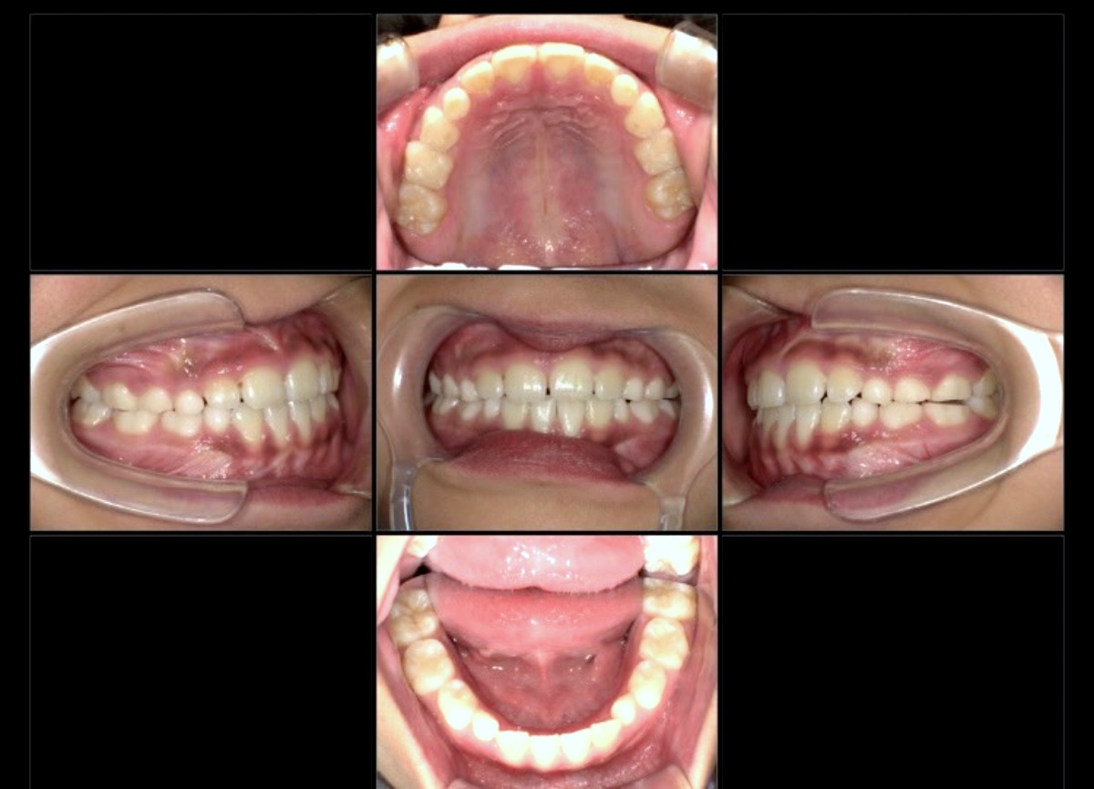 小児矯正症例：八重歯、上下の歯のジグザグ(叢生)