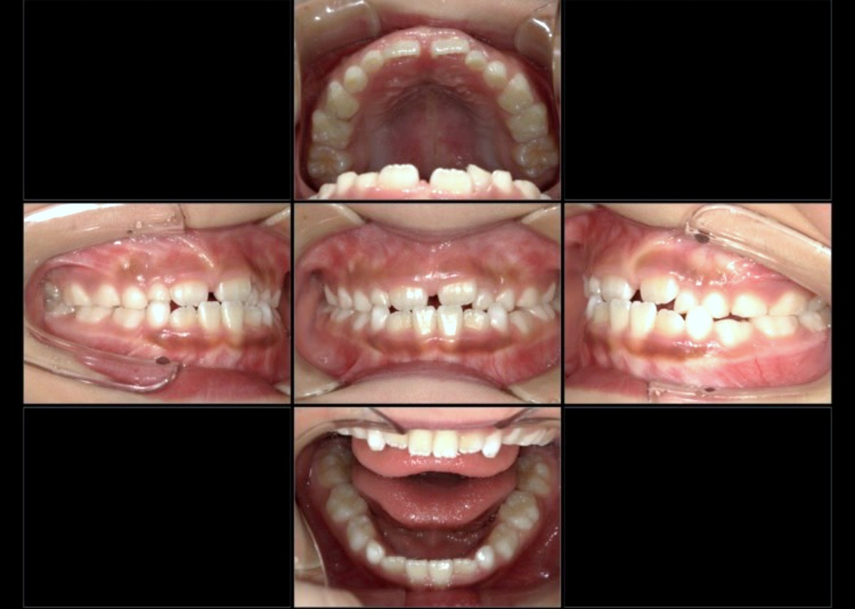 小児矯正症例：八重歯、上下の歯のジグザグ(叢生)