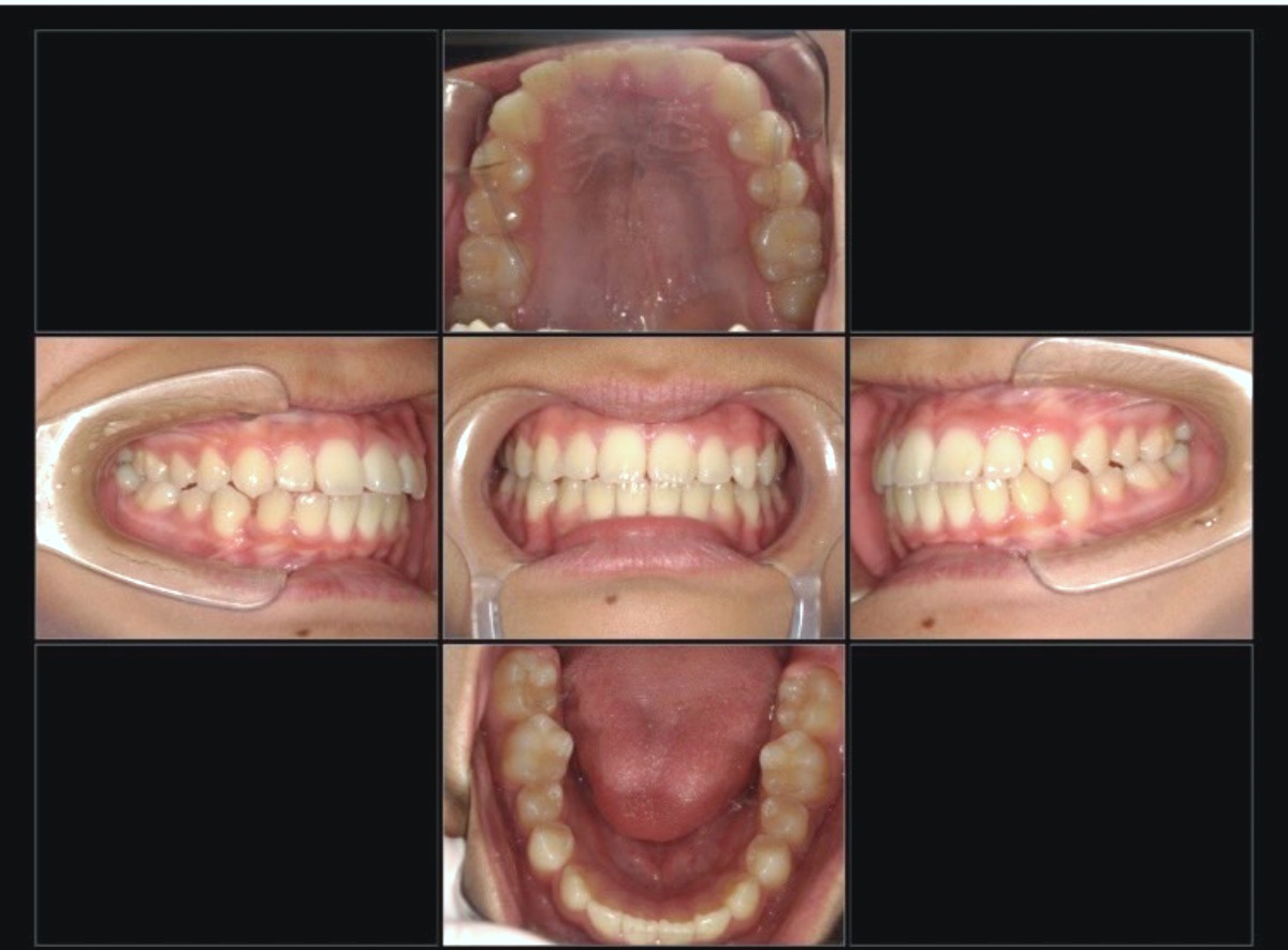 小児矯正症例：前歯の突出感