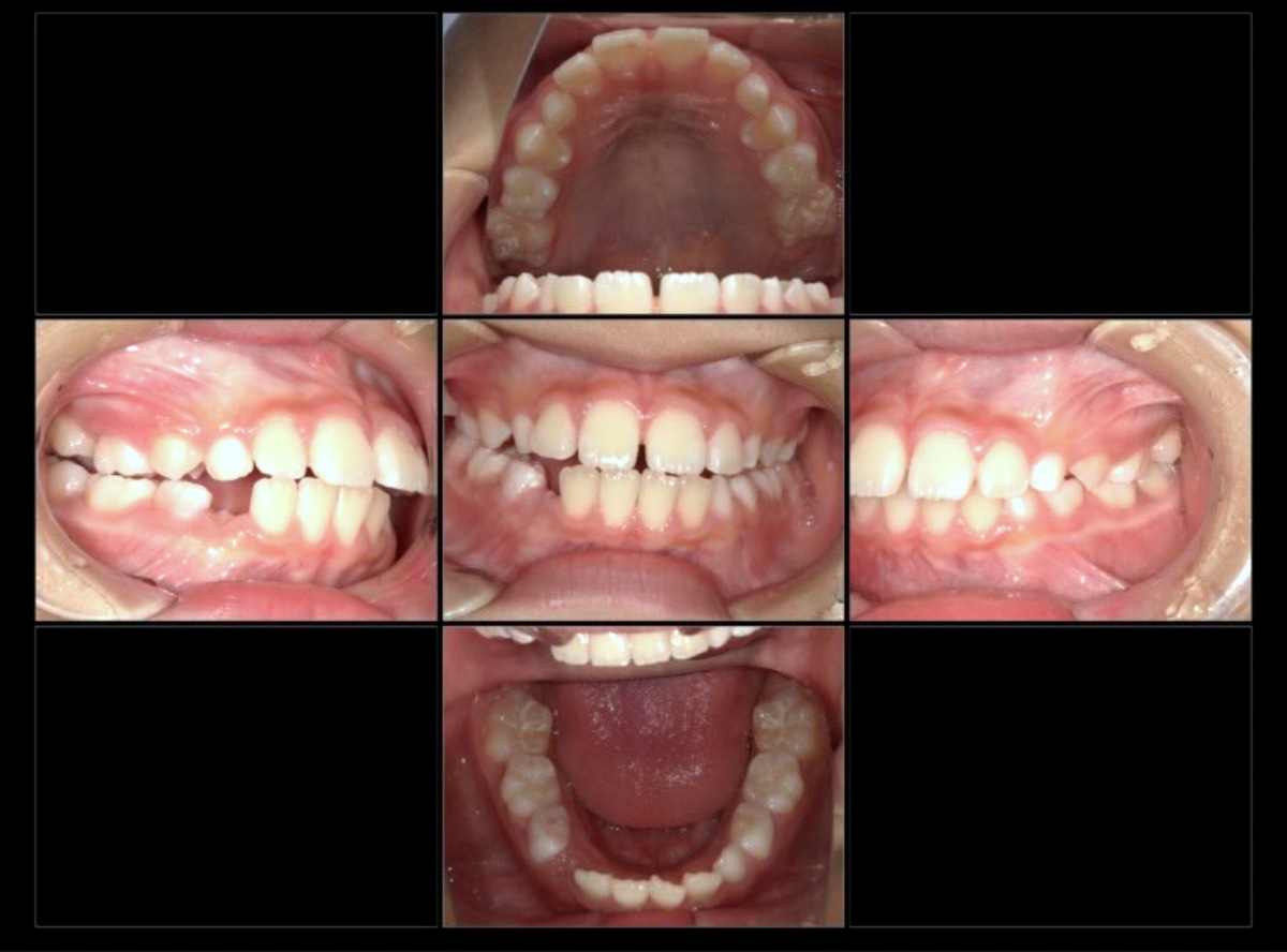 小児矯正症例：前歯の突出感